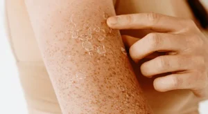 Applying on Broken or Irritated Skin