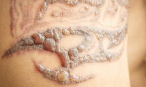 Safety Considerations & Side Effects