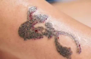 Common Tattoo Healing Issues & How Recovery Cream Helps