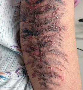 Signs Your Tattoo May Be Infected