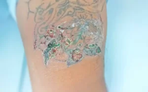 Effects of Bad Tattoo Aftercare