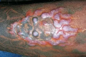 Possible Risks and Side Effects
