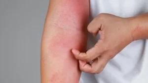 Possible Side Effects of Nupharmisto Tattoo Numbing Cream