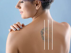 Benefits of Using Natural Tattoo Removal Cream