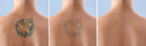 What Is Tattoo Removal Cream